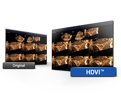 Samsung HM70 ultrahang készülék HDVI nagyfelbontású képalkotás