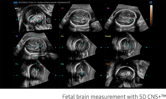 Samsung WS80 ultrahang készülék 5D CNS Fetal brain méréssel