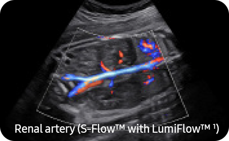 Samsung LumiFlow™ képalkotás a szülészeti ultrahangban