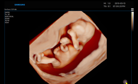HERA W9 - early fetus with RealisticVue™