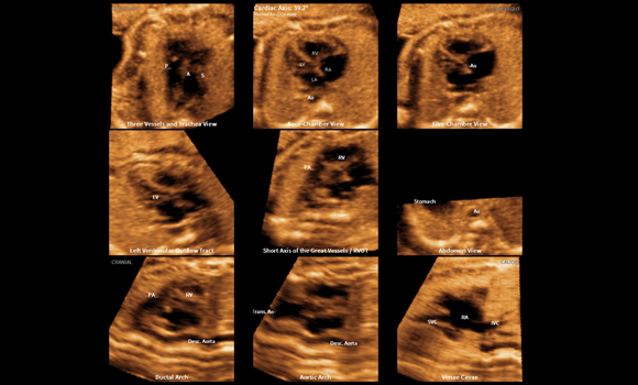 9 fetal heart standard views with 5D Heart ColorFetal face with RealisticVue™