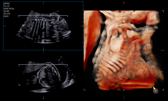 Fetal ribs and scapula with CrytalVue™