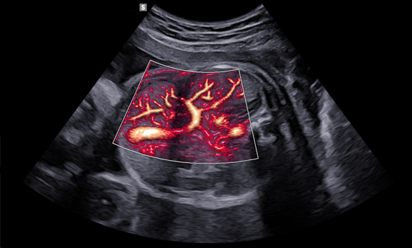 MV-FLow with Lumiflow - Fetal abdomen