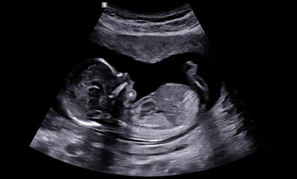1st trimester fetal profile view